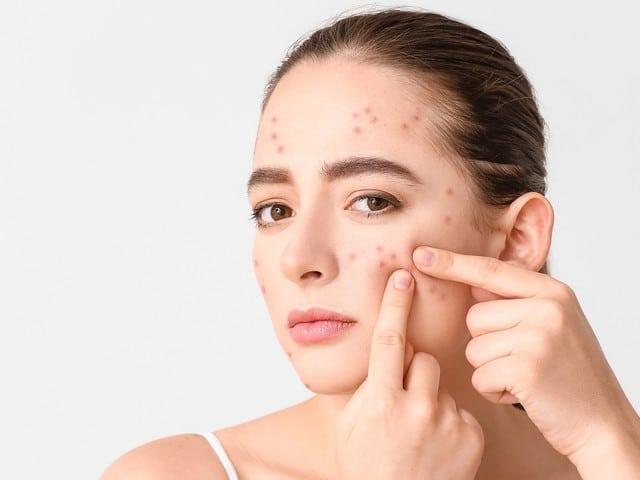 5 Top Cream for skin that are suitable for people with Acnes to try today