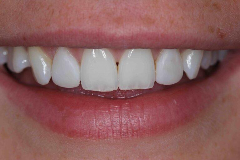 Dental Veneers Advantages and How to Take Care of Them