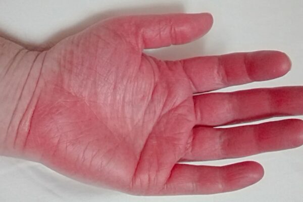 Understanding Erythromelalgia Pain: Causes, Symptoms, and Treatment Options